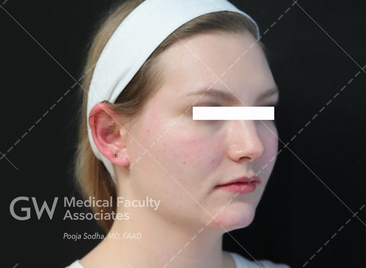case one post-treatment