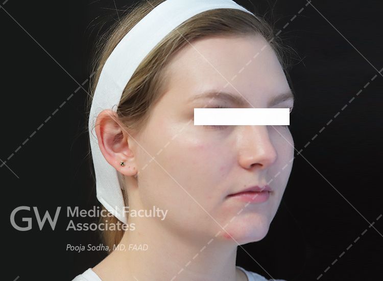 case one pre-treatment