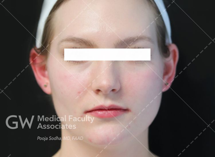 case one post-treatment