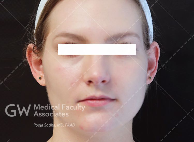 case one pre-treatment