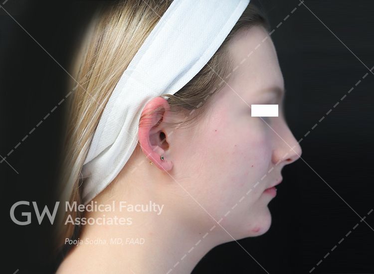 case one post-treatment