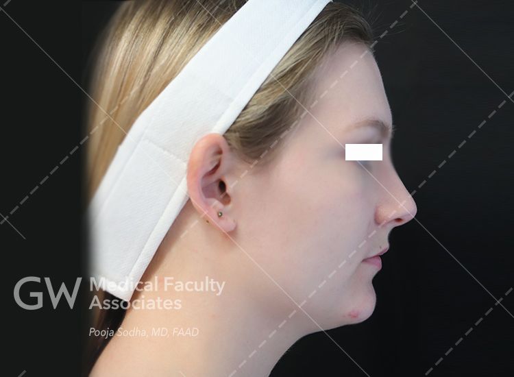 case one pre-treatment