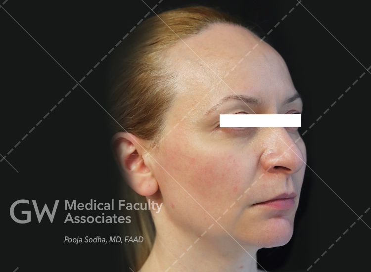 post-treatment looking at right angle