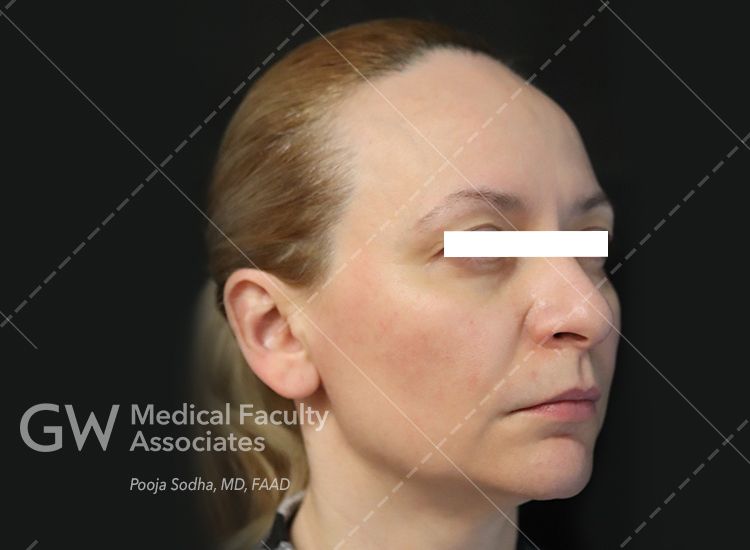 pre-treatment looking at right angle