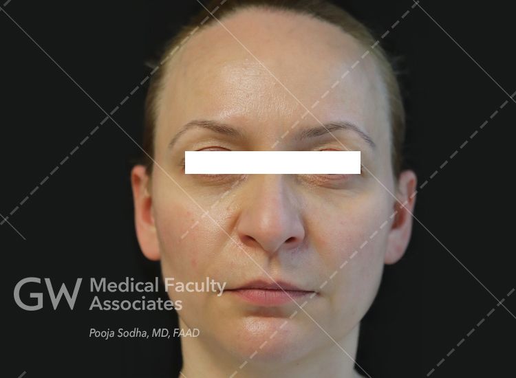 post-treatment facing forward