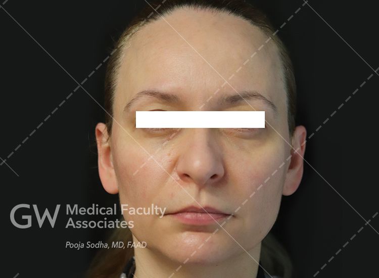pre-treatment facing forward