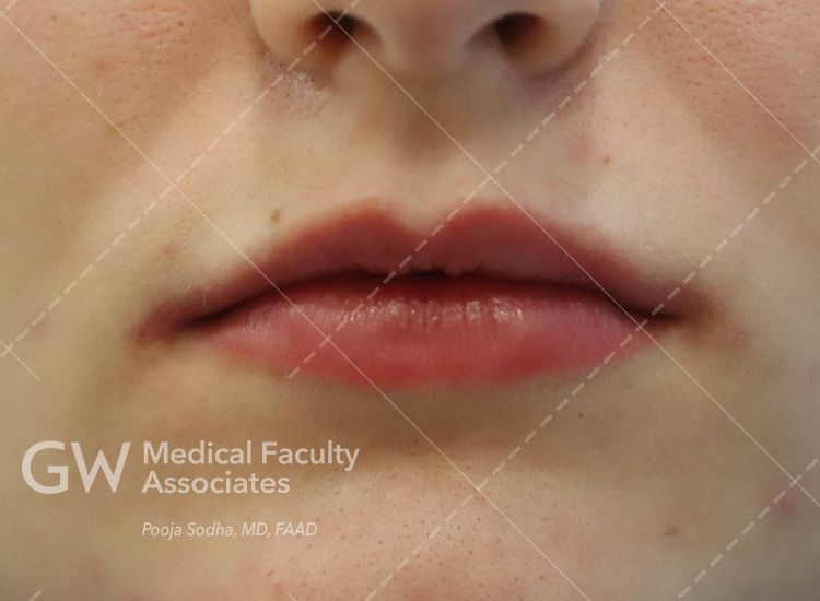 case two post-treatment 