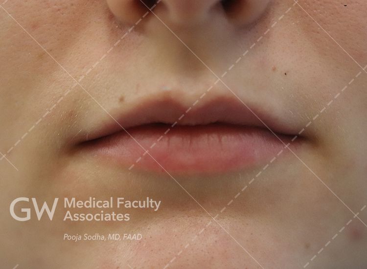 case two pre-treatment