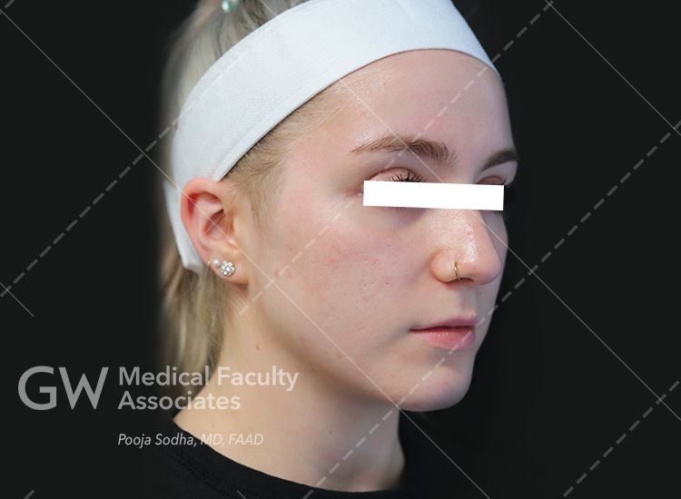 case three pre-treatment