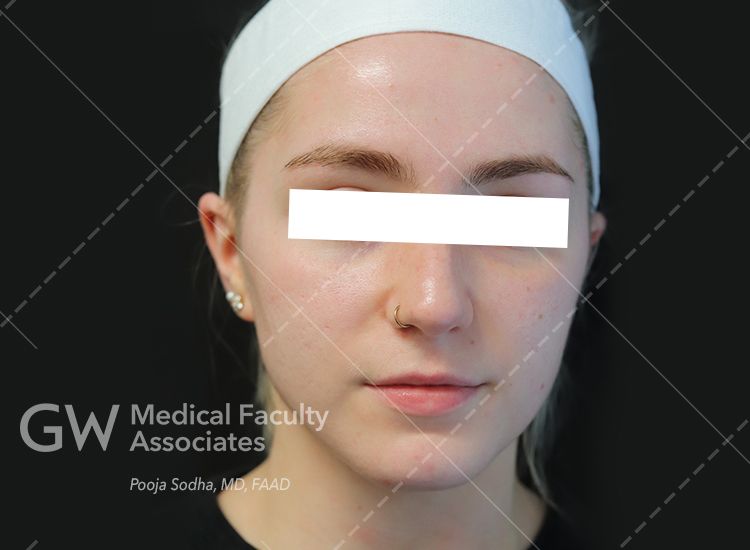 case three pre-treatment