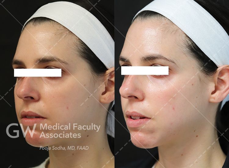 case 4 pre and post treatment