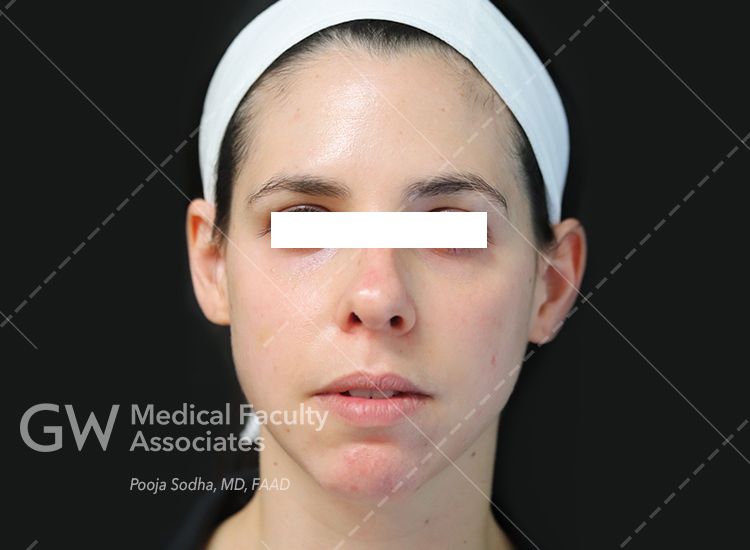 case 4 post-treatmetn