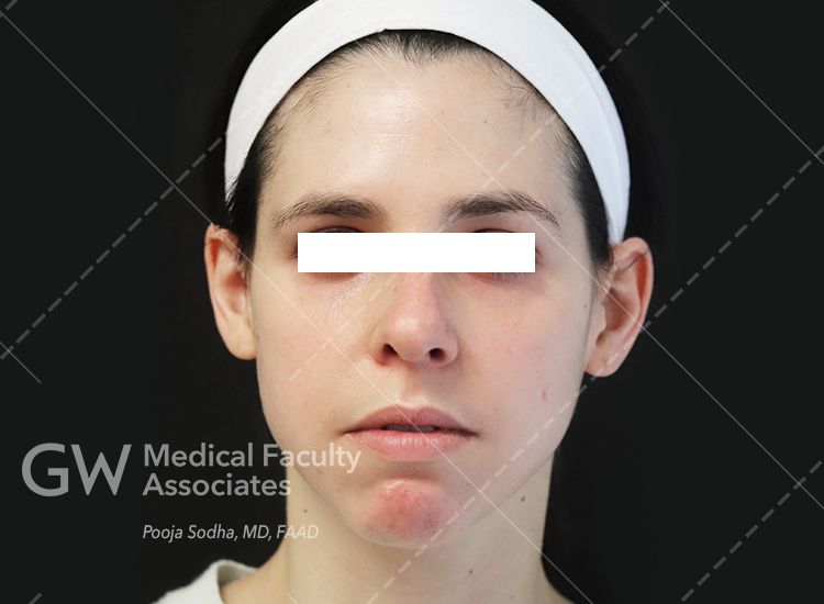 case 4 pre-treatment