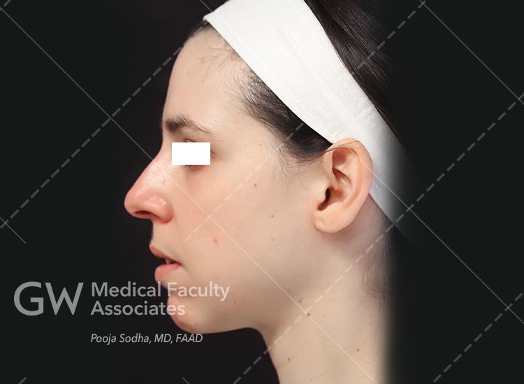 case three pre-treatment