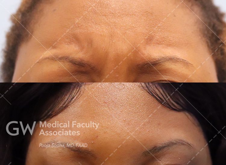 case five pre and post treatment while frowning