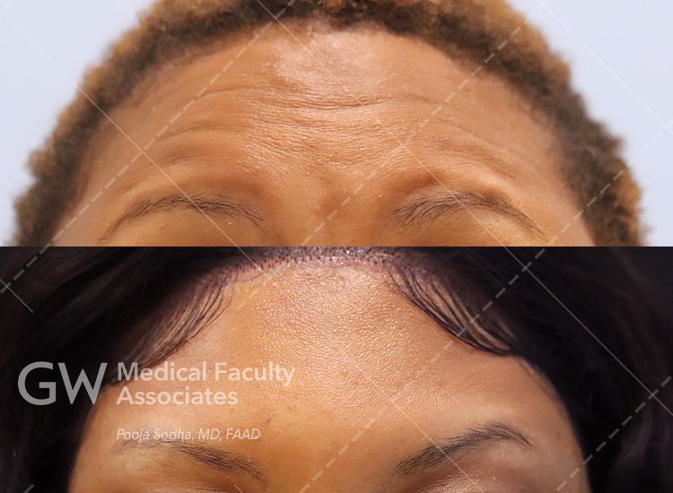 case 5 stacked before and after