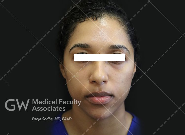 post-treatment