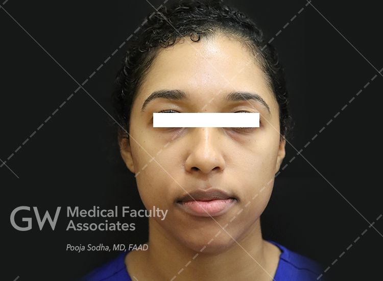 pre-treatment