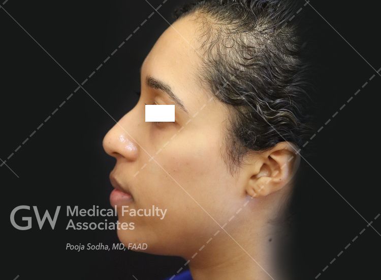 post-treatment