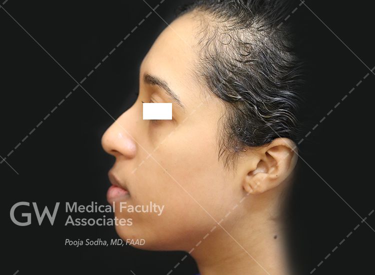 pre-treatment