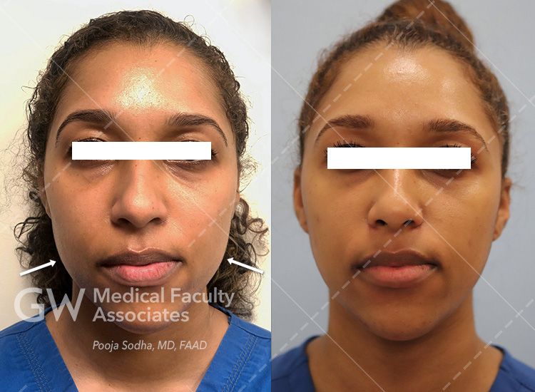 case six pre and post treatment